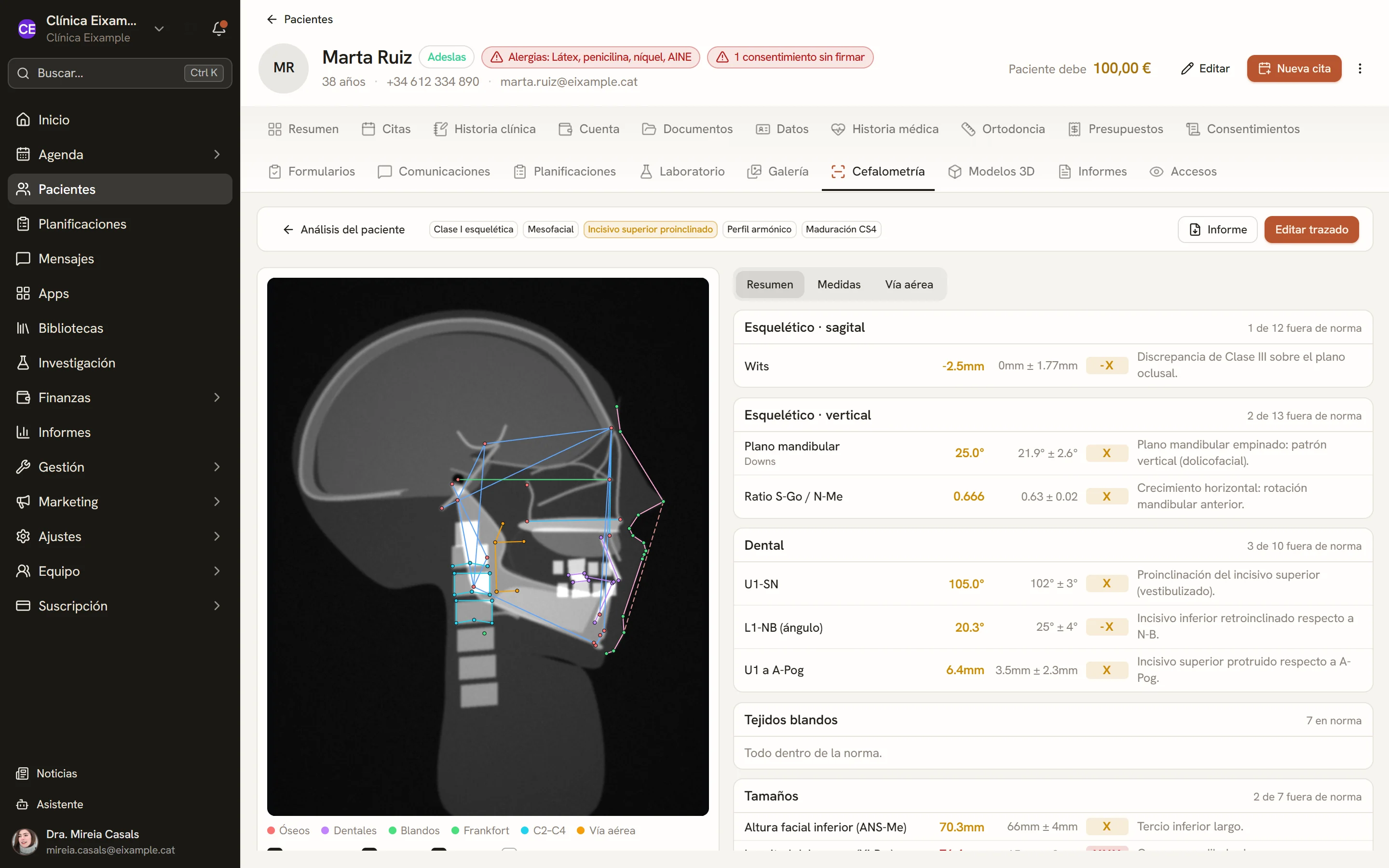 Trazado cefalométrico sobre una telerradiografía de muestra, con la tabla de medidas.